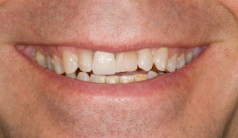 Worn damaged smile before cosmetic dentistry