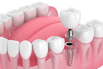 Illustration of single dental implant