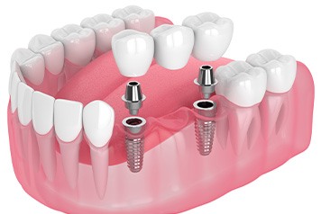 Illustration of implant bridge