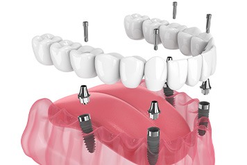 Illustration of implant denture