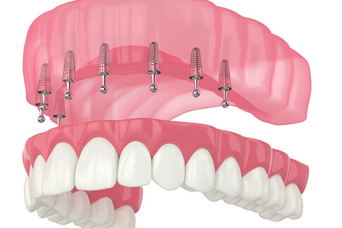 illustration of ball-retained implant dentures