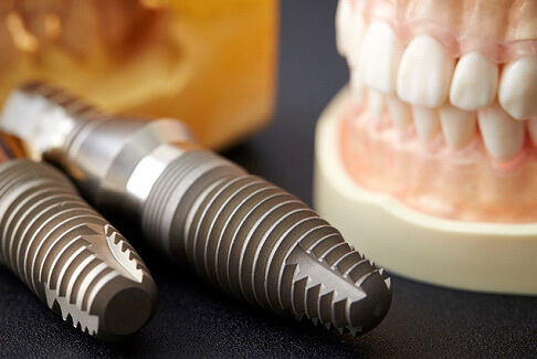 closeup of model teeth and implants on a dark surface