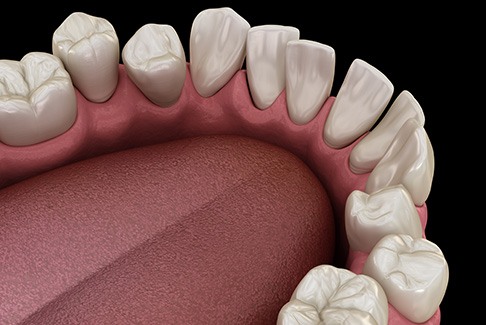 Illustration of gapped teeth