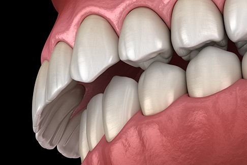 Illustration of overbite