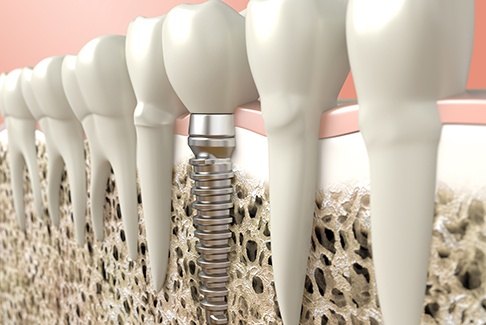 Digital illustration of a dental implant