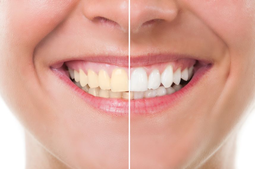 A before and after teeth whitening closeup of a woman’s smile